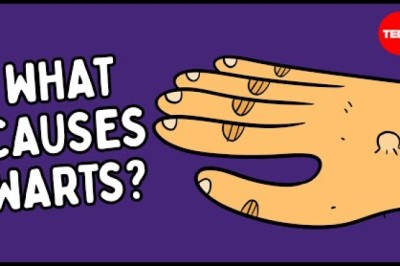 What Are Warts — and How Do You Get Rid of Them?